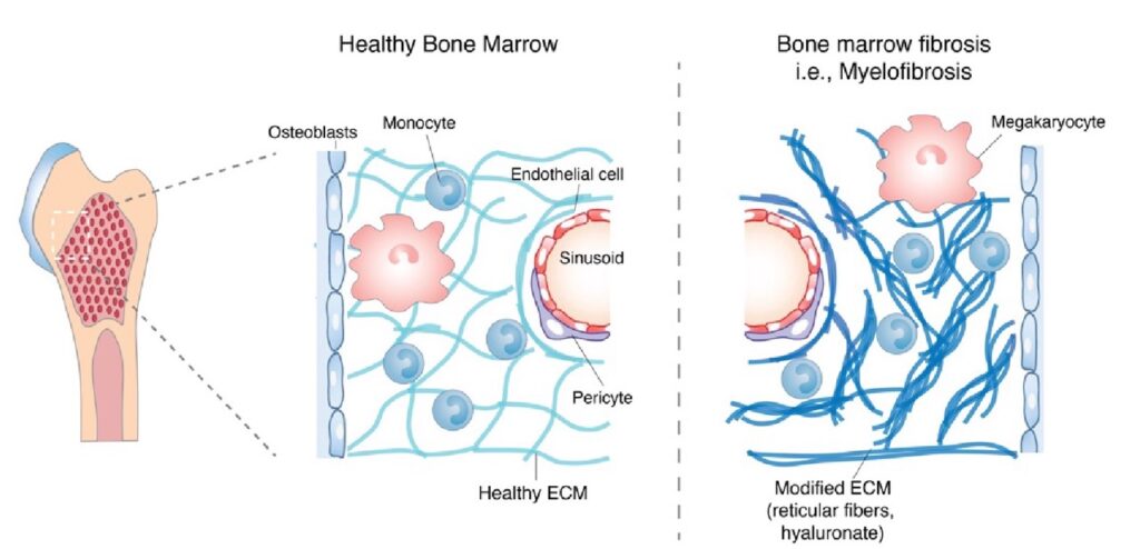 Fibrosis diagram